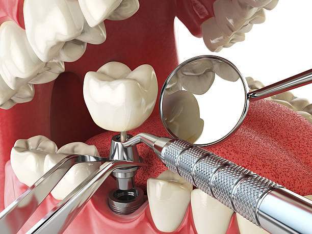 Best Emergency Root Canal Treatment in Horseshoe Bay, TX
